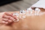 141816427 - Therapist Placing Cups On Person's Back
